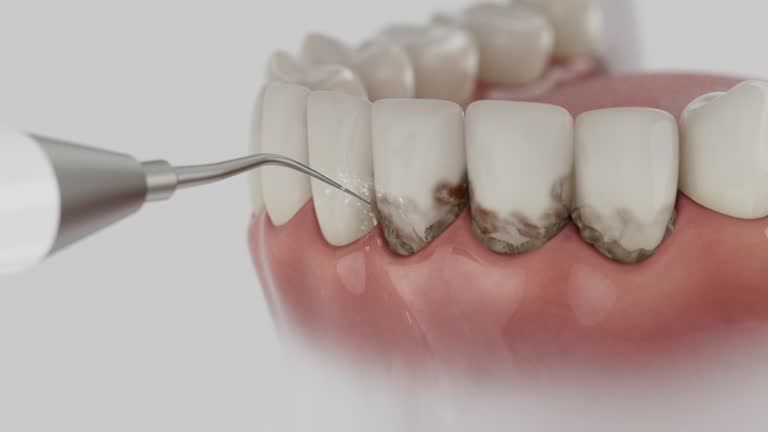Reliable Dental Implants contractor in Marina, CA by Smile Center Dentistry